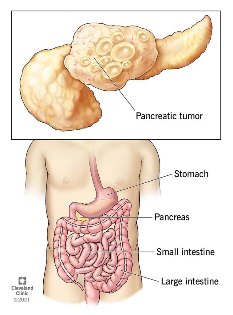 What is pancreatic cancer