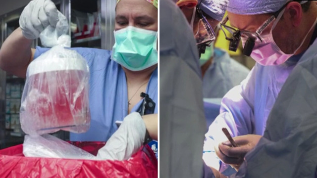 First human recipient of pig kidney transplant dies